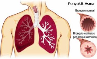 Inilah Obat Asma Alami Paling Mujarab