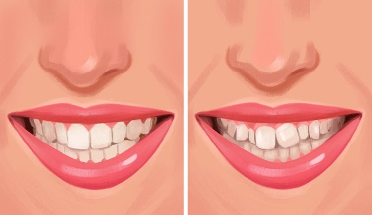 Diş yapınız etkilenebilir