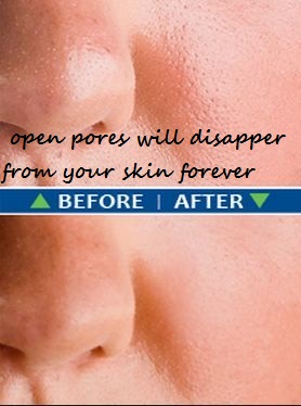 open pores will disapper from your skin forever