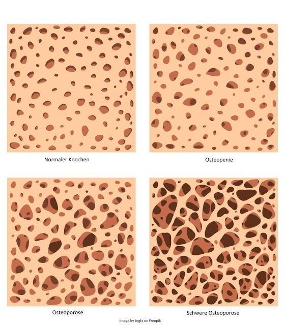 Vektorgrafik der Knochenstruktur von normalem Knochen und verschiedenen Stadien der Osteoporose