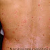 সোরিয়াসিস(psoriasis) রোগের চিকিৎসা সফলতা অর্জন