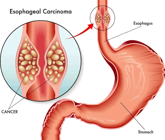 esophagus-cancer-causes