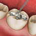 Quy trình trám răng an toàn