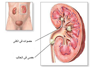 حصى الكلى