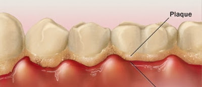 Viêm nha chu là nguyên nhân gây chảy máu răng