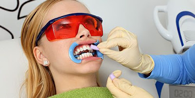 Tẩy trắng răng có ưu điểm gì ?