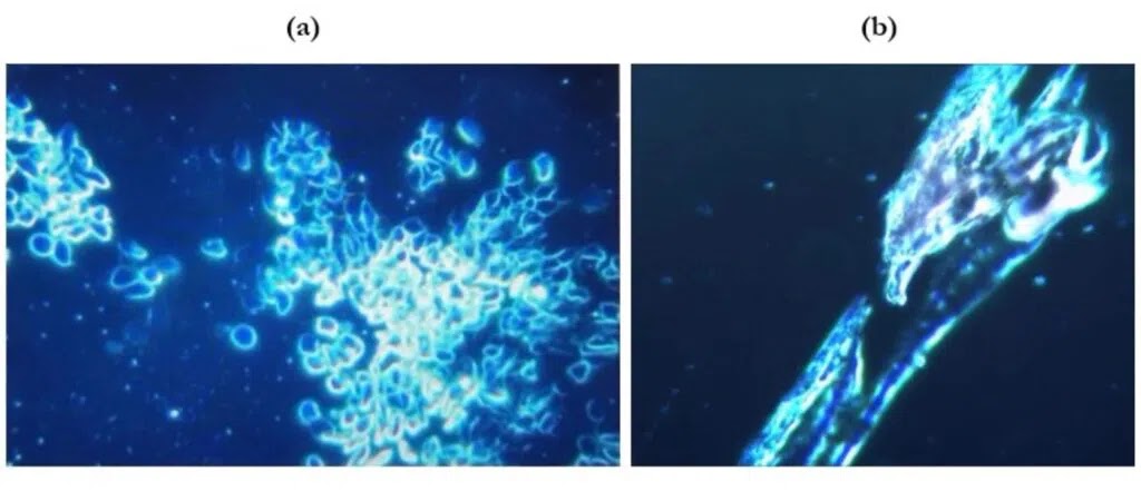 (a) Deformation and erythrocyte aggregation with signs of hemolysis at 40x magnification. (b) A foreign crystallized tubular structure at 120x magnification. (Source: IJTPVR)