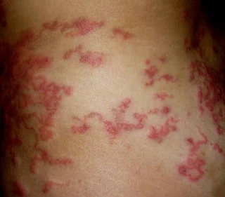 Killing scabies using vaseline paste over a long time