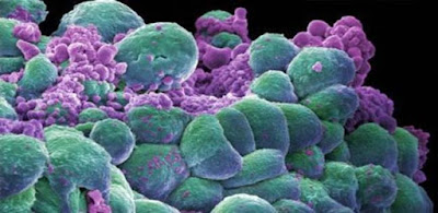  الخلايا السرطانية 