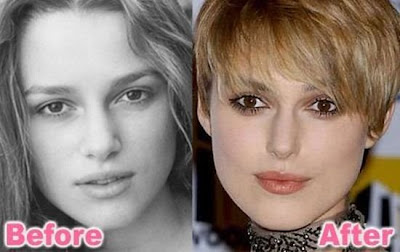 celebrity plastic surgery