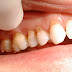 Cách điều trị răng bị ê buốt tại nha khoa