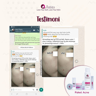  Testimoni Review Paket Penghilang Jerawat Pratista Ampuh Dan Bpom (186)