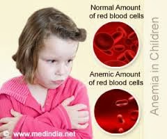 Manjaku Cergas: Penyakit Anemia dikalangan kanak-kanak