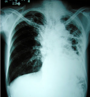 Nursing Diagnosis Ineffective Airway Clearance related to Pulmonary Tuberculosis