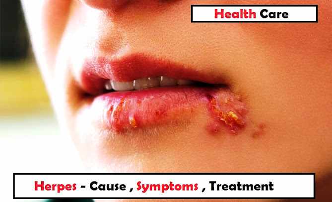 Herpes (HSV) - Cause ,Symptoms ,Treatment
