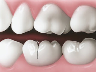 Răng sứ có bị sâu không ?