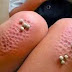 Asal Mula Penyakit Aneh Trypophobia Yang Menakutkan