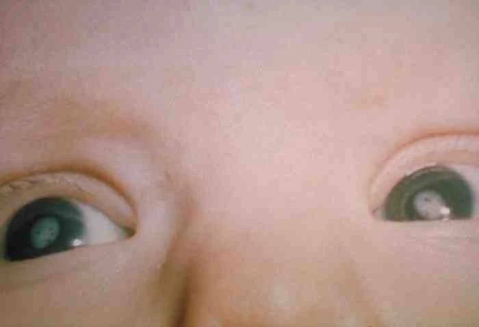 congenital cataract