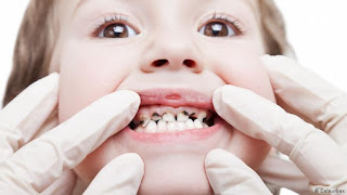 افضل الطرق لعلاج تسوس الاسنان