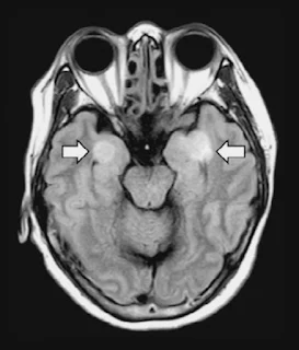 Uma mulher de 58 anos de idade com COVID-19 desenvolveu encefalite, resultando em danos nos tecidos do cérebro (setas). N. POYIADJI  ET AL. ,  RADIOLOGY , (2020)  DOI.ORG/10.1148/RADIOL.2020201187
