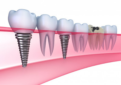 Ghép răng Implant khỏe như răng thật