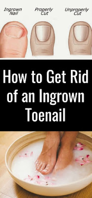 How To Get Rid Of An Ingrown Toenail: Natural Remedies!!!!