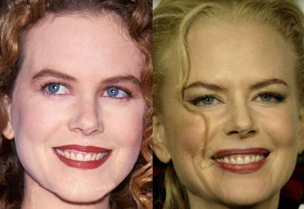 Celebrity Plastic Surgery on Nicole Kidman Before And After   Image Hosted By Http   Chatterbusy