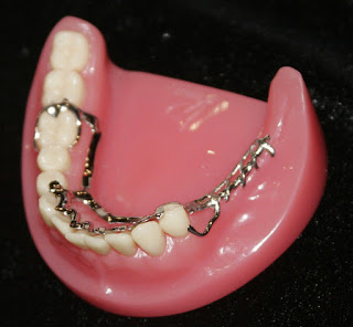 Giải pháp cho những người bị mất nhiều răng là gì?
