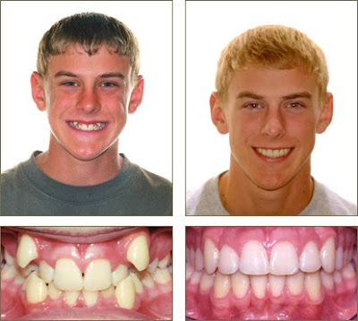 Before And After Braces Picture
