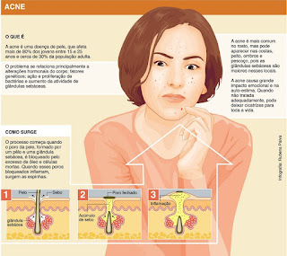  causa acne, espinhas na cara como tirar, acne imagens, acne tratamento caseiro, acne o que é, acne como tratar, acne na cara, acne causas, tratamento acne medicamentos