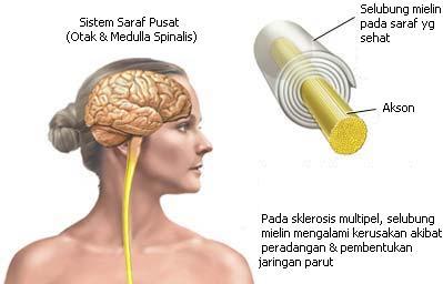 sklerosis multipel
