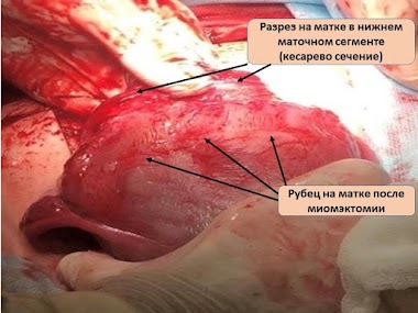 Клиническое наблюдение посвящено возможности осуществить репродуктивную функцию у больной с огромным миом атозным узлом