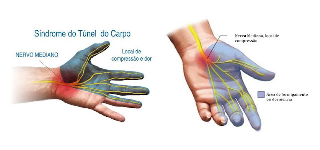 Síndrome do Túnel do Carpo