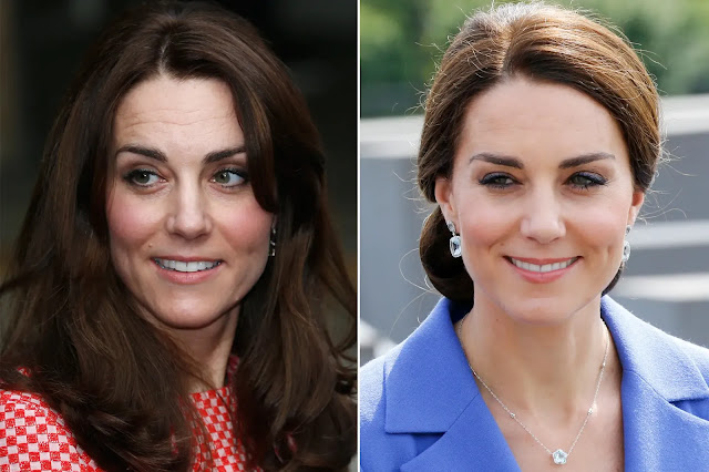 Has Kate Middleton Undergone Plastic Surgery
