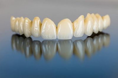 Nguyên nhân răng sứ bị mẻ là gì?