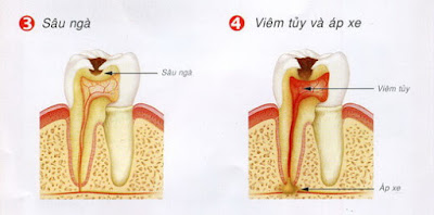 Răng chết tủy có niềng được không? 