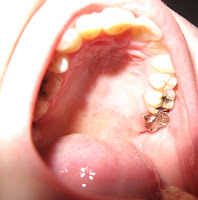 Black Hole On Tooth5