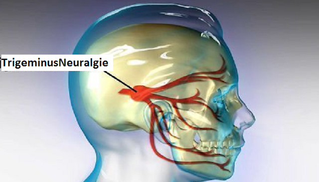 trigeminusneuralgie diagnose