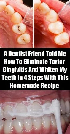 My Dentist Brother Told Me How To Eliminate Tartar, Gingivitis And Whiten My Teeth In 4 Steps With This Homemade Recipe