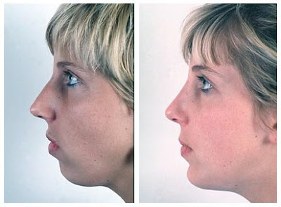 Chin Augmentation Before And After
