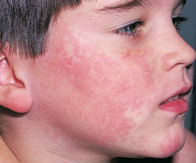 Fifth Disease Rash Pictures7