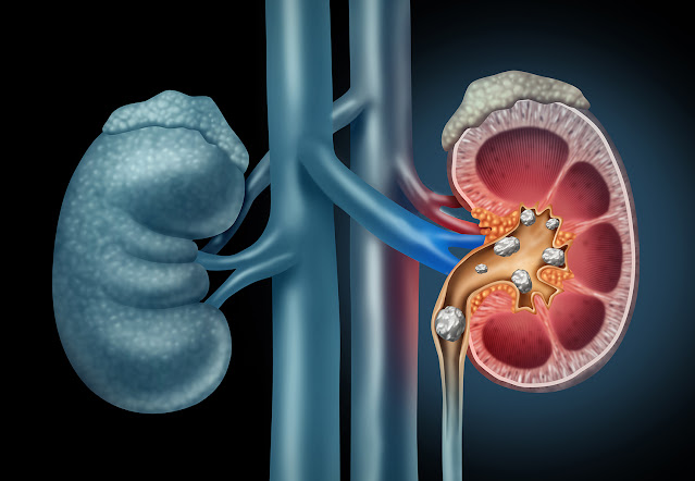 kidney stone dissolver