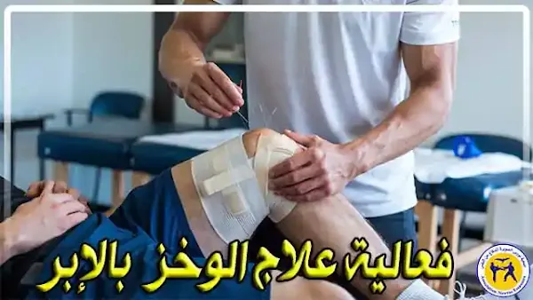دور الوخز بالإبر في علاج إصابات الرياضيين
