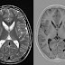 View 23: Huntington's Disease Brain Atrophy