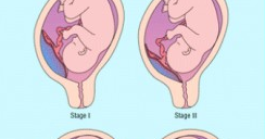 Tips atasi Uri DiBawah atau Placenta Previa ~ Cara Hidup Sihat