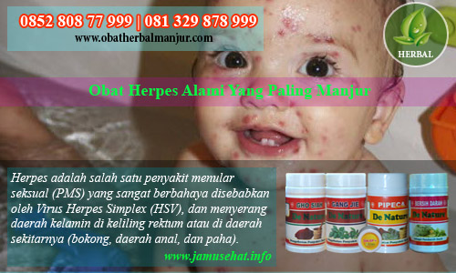 obat herpes herbal