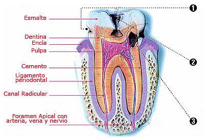 Dibujo de la caries dental indicando partes a color