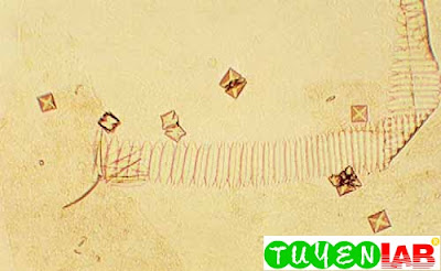 Calcium oxalates, amorphous urates, and a piece of debris