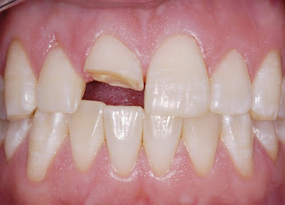 Nguyên nhân khiến răng bị sứt mẻ 