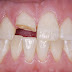 Nguyên nhân khiến răng bị sứt mẻ 